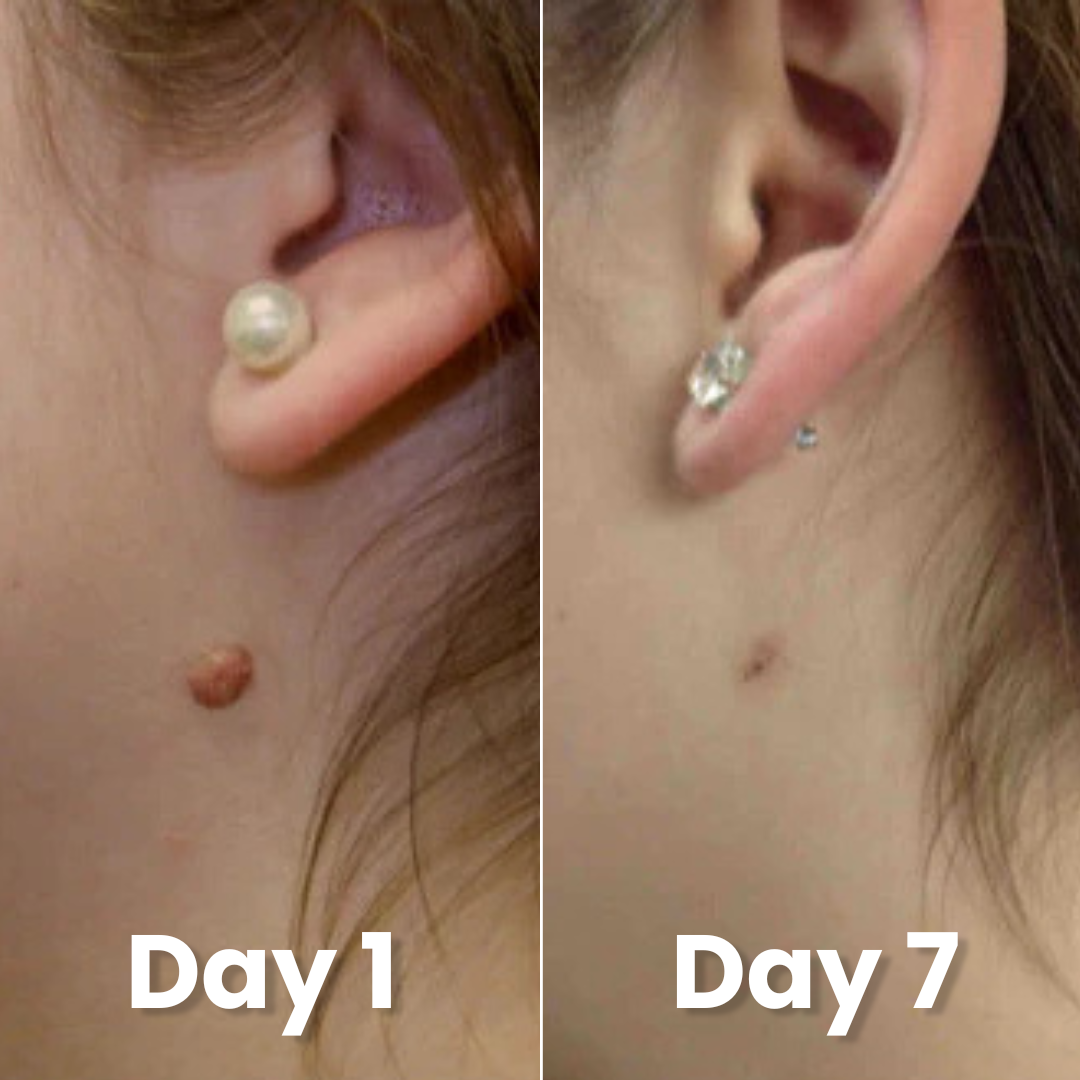 Kivo Skin Tag Pen