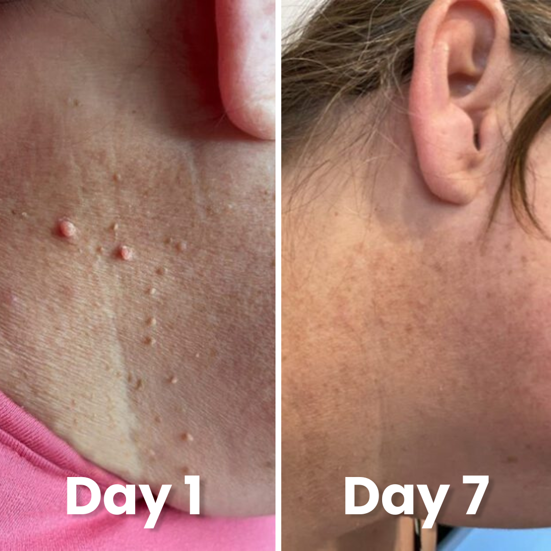 Kivo Skin Tag Pen