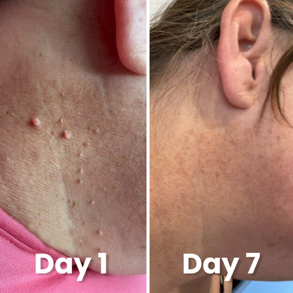 Kivo Skin Tag Pen